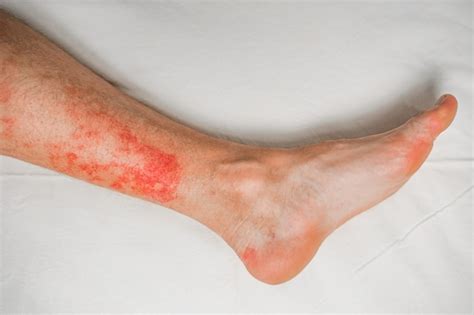 fotos de alergia nas pernas